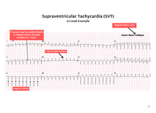 Load image into Gallery viewer, ECG Pocketbook 2nd Edition - Digital version