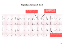 Load image into Gallery viewer, ECG Pocketbook 2nd Edition - Digital version